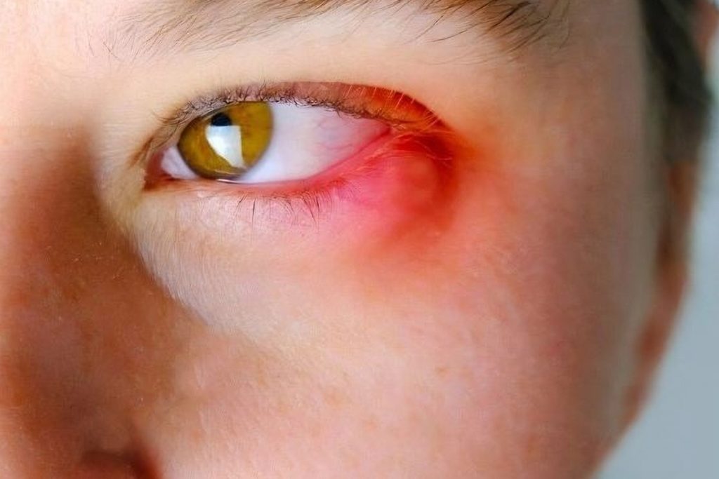 What Is BLEPHARITIS (Inflammation of the Eyelash Bases)?
